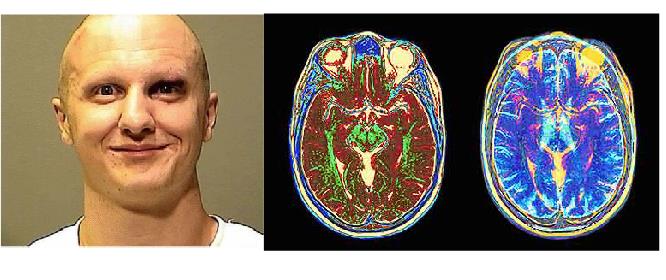 Loughner and brain imaging